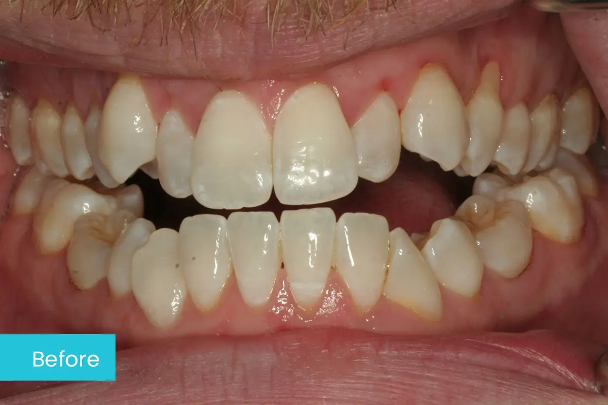 invisalign-before-2-msd
