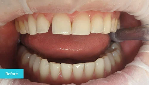 invisalign-before-6