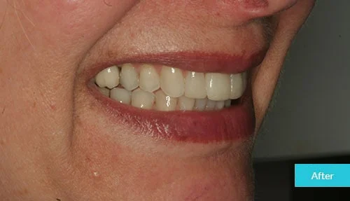 invisalign-bonding-after-museum1