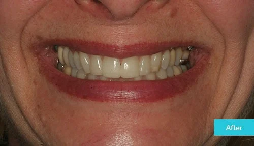 invisalign-bonding-after-museum2