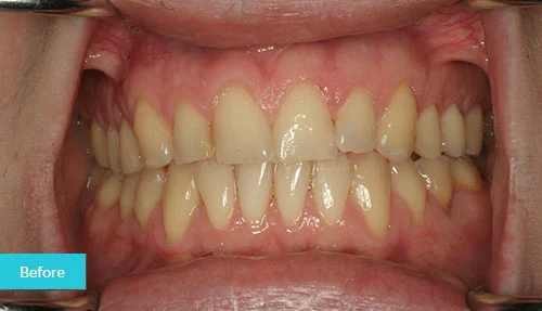 invisalign-bonding-before-museum