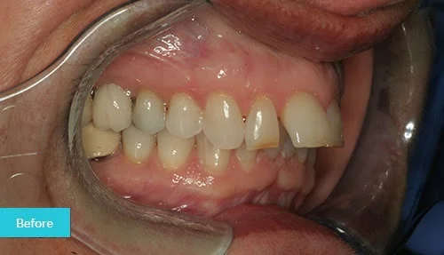 invisalign-bonding-before-museum1