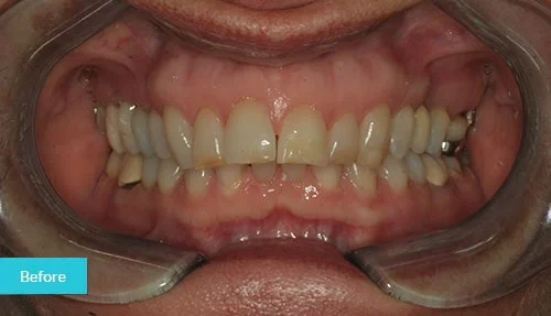 invisalign-bonding-before-museum2