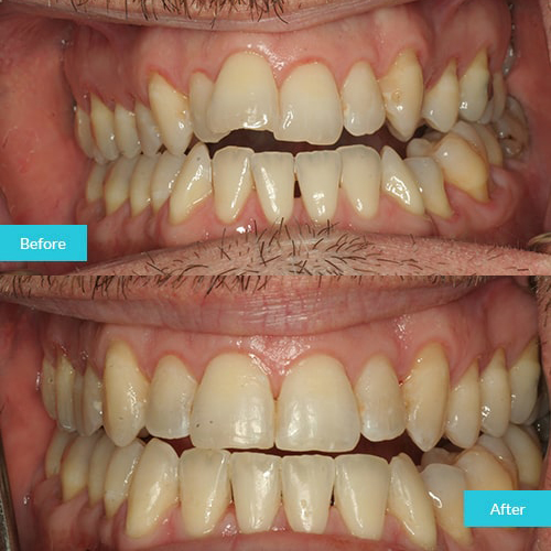 invisalign-case-1-home