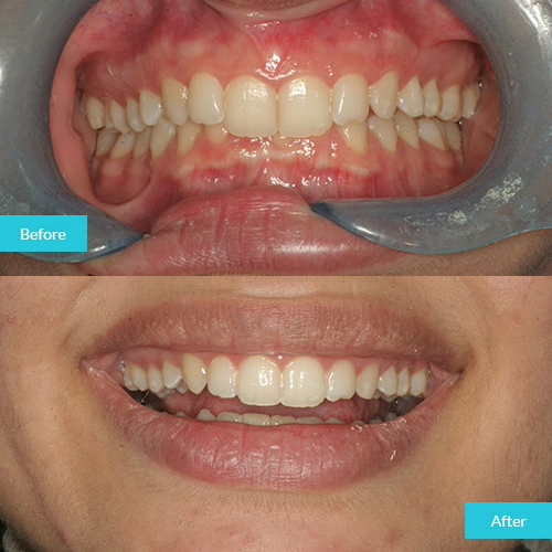 invisalign-case-2-home