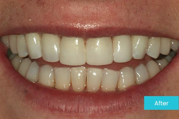 invisalign-galley-after-1
