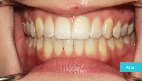 invisalign-lite-after