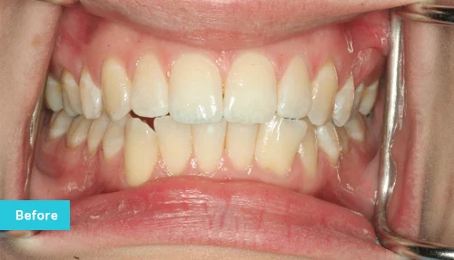 invisalign-lite-before
