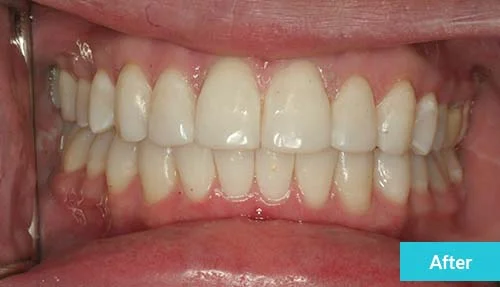 invisalign-lite-teeth-whitening-and-dental-bonding-after-2