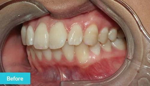 invisalign-lite-teeth-whitening-and-dental-bonding-before-1