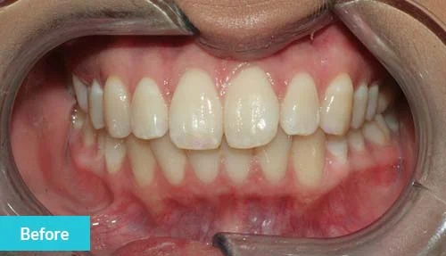 invisalign-lite-teeth-whitening-and-dental-bonding-before-2