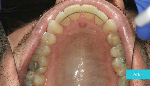 invisalign11-after