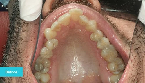 invisalign11-before