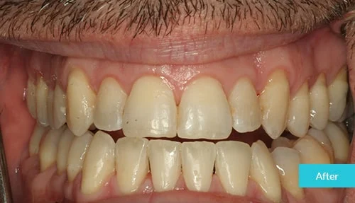 invisalign12-after