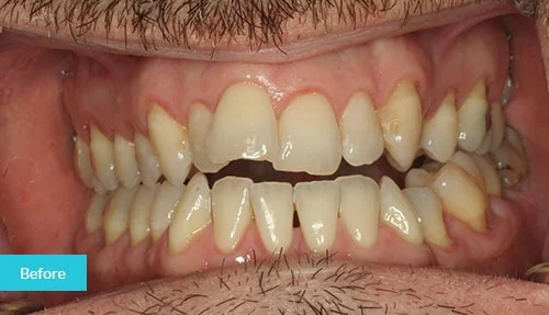 invisalign12-before