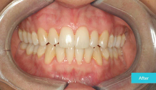 invisalign_case_1_after