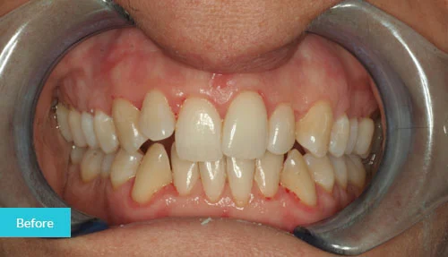 invisalign_case_1_before