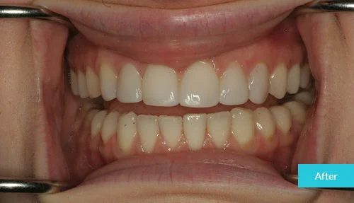 museumdentalsuites-bonding-after
