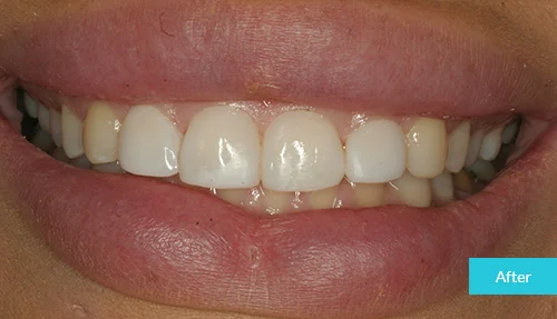 museumdentalsuites-bonding-after2