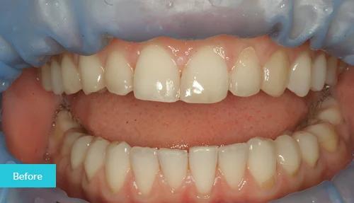 museumdentalsuites-bonding-before