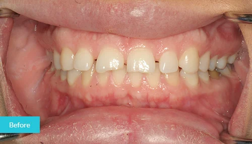 museumdentalsuites-bonding-before2