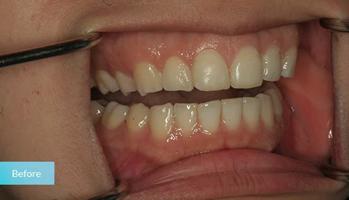 museumdentalsuites-bonding-for-tooth-wear-before