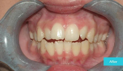 museumdentalsuites-invisalign-after