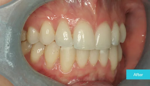 museumdentalsuites-invisalign-after1