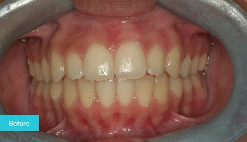 museumdentalsuites-invisalign-before