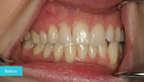 museumdentalsuites-invisalign-before1