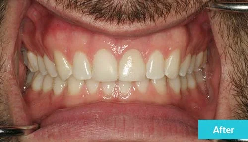 single-dental-crown-after-1