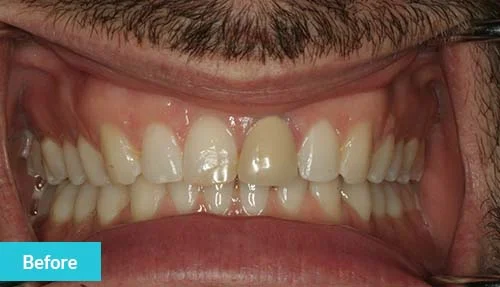 single-dental-crown-before-1