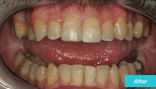 smile-improvement-after-1