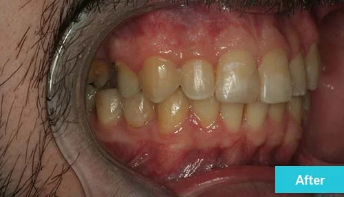 smile-improvement-after-2