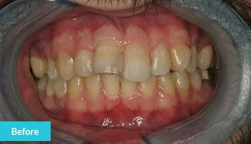 smile-improvement-before-1