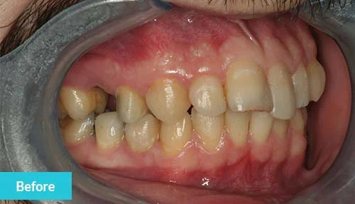 smile-improvement-before-2