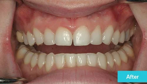 teeth-bonding-after-2