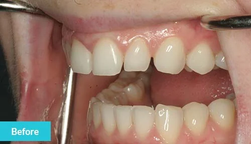 teeth-bonding-before-1