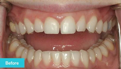 teeth-bonding-before-2