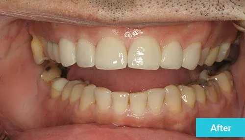 teeth-reconstruction-after-1