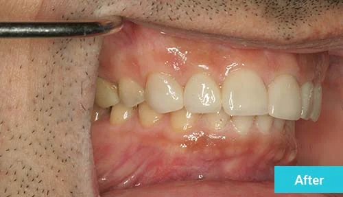 teeth-reconstruction-after-2
