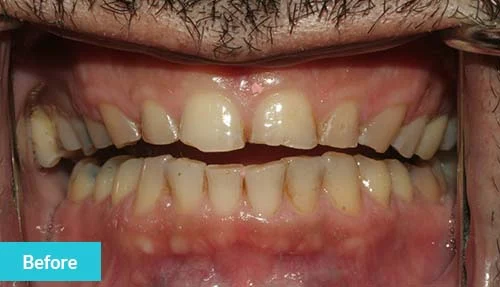 teeth-reconstruction-before-1