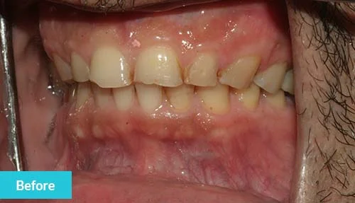 teeth-reconstruction-before-2