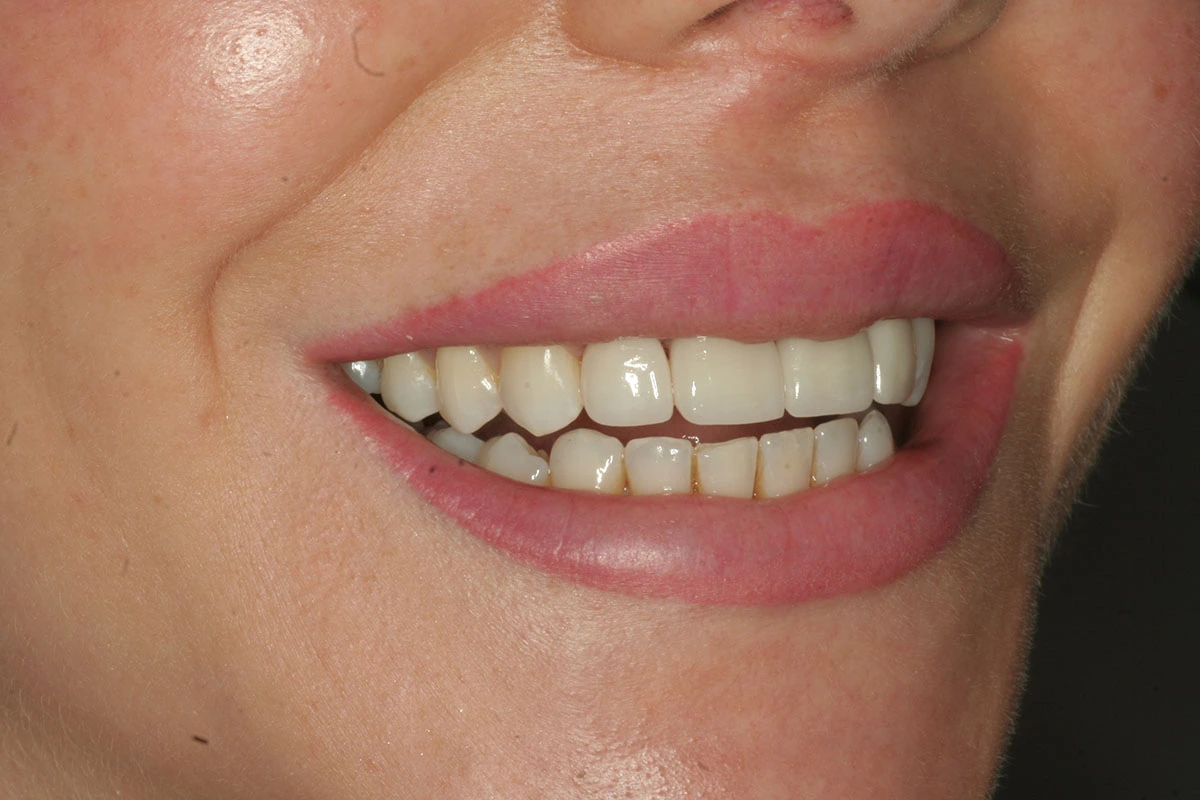 veneers-2-msd