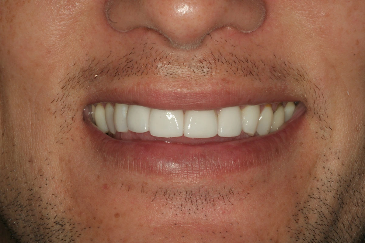 veneers-msd