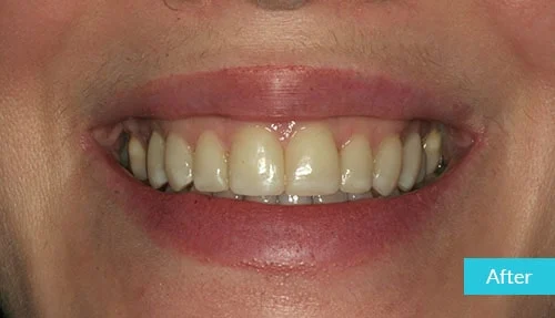 veneers1_after