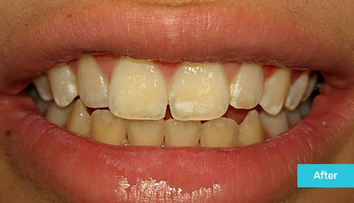 white-spot-treatment-icon-therapy-after