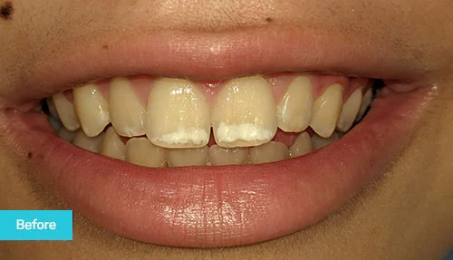 white-spot-treatment-icon-therapy-before