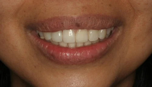 159799242342348019673invisalign-before-2