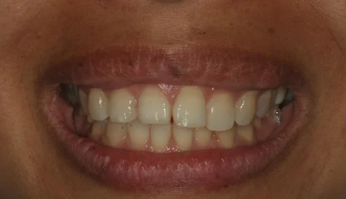 159799801962342342373invisalign-before-2
